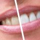 Teeth whitening in Henderson